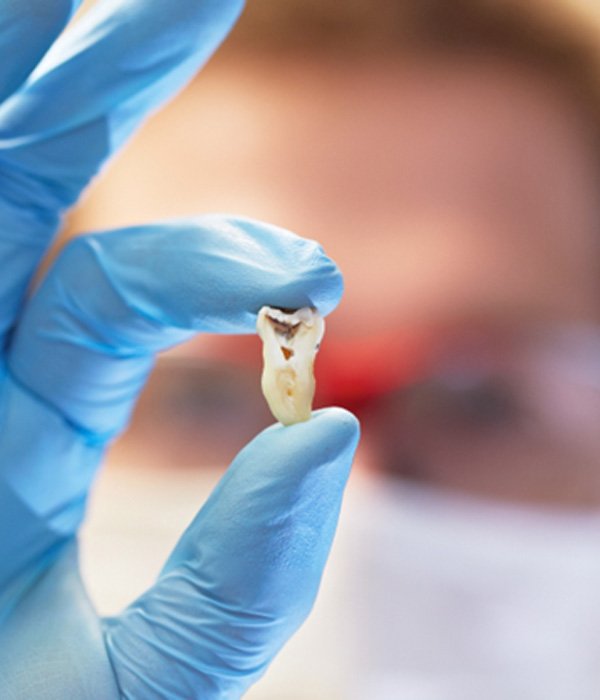 Periodontist holding a tooth after tooth extraction in Colorado Springs, CO