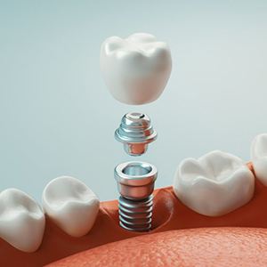 Diagram explaining how dental implants in Colorado Springs work