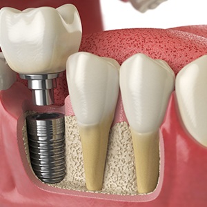 Diagram showing osseointegration process of dental implants in Colorado Springs 