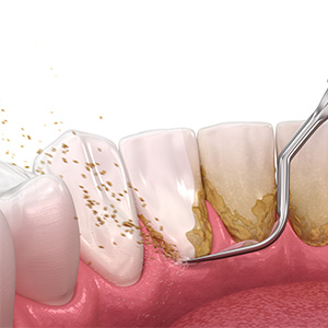 A graphic illustration of a scaler clearing plaque from teeth