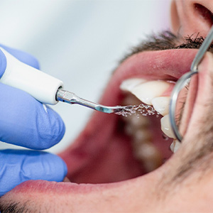 A man having his teeth cleaned