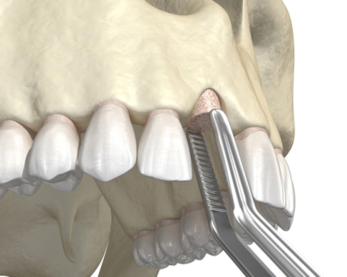 diagram of bone grafting in Colorado Springs