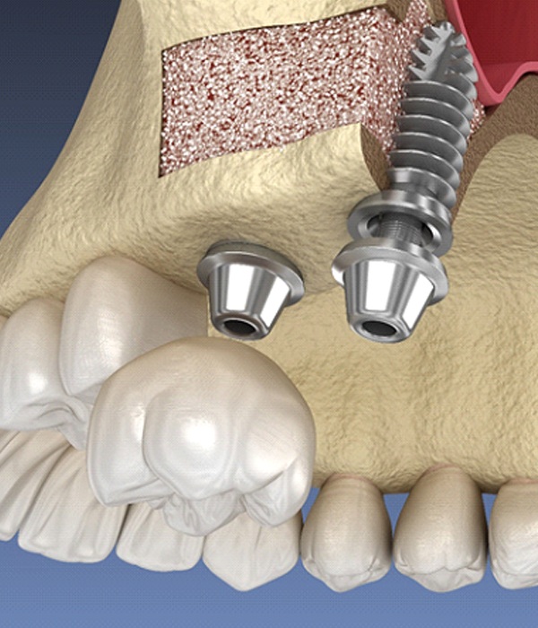 diagram of bone tissue for dental implants