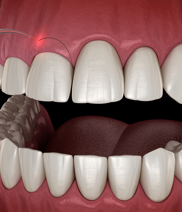 Aimated smile during crown lengthening