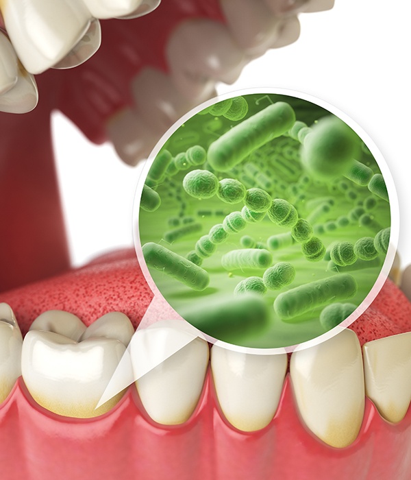 Animated smile with enlarged bacteria visible