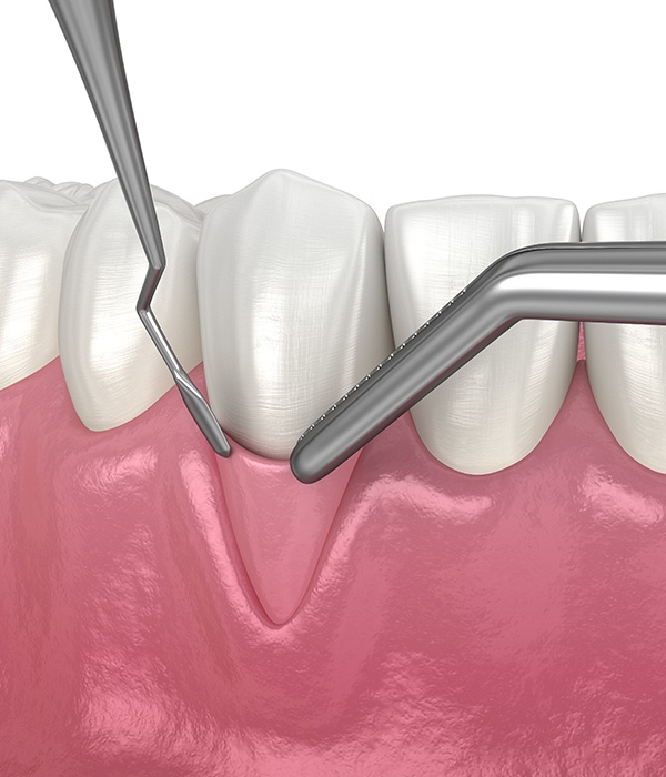 Animated gum grafting procedure