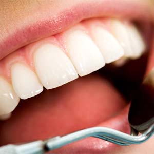 Closeup of mouth from person receiving a dental exam