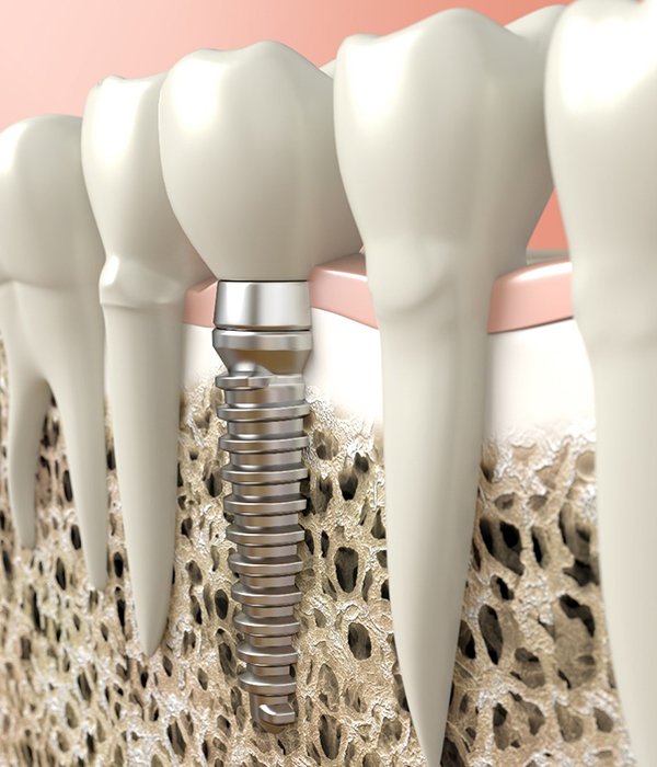 diagram of dental implants in Colorado Springs