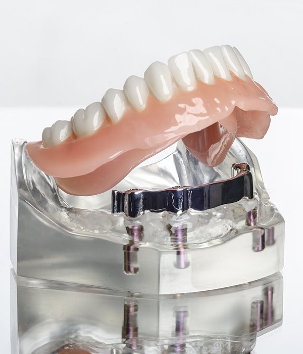 Model smile with dental implant retained denture