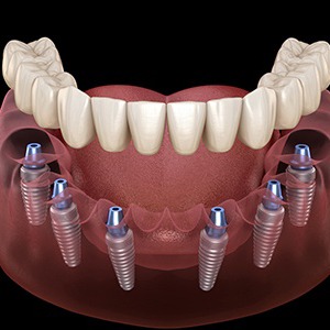 Diagram showing how implant dentures in Colorado Springs work