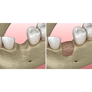 Diagram of how bone grafting in Colorado Springs works 