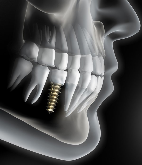 X-ray diagram of dental implants in Colorado Springs