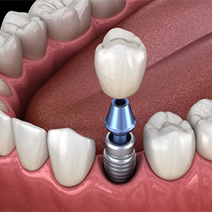 Diagram showing single tooth dental implant in Colorado Springs