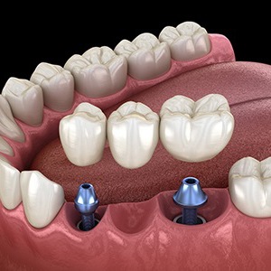 Diagram showing implant bridge replace multiple missing teeth in Colorado Springs
