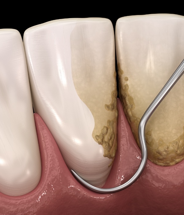 Animated smile during scaling and root planing treatment