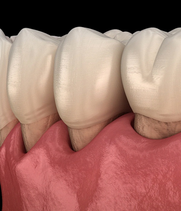 receding gums from advanced periodontitis
