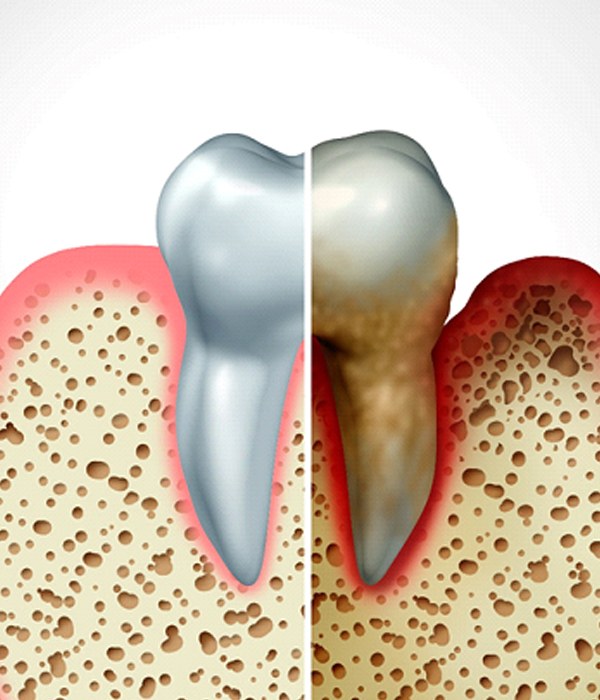 Healthy tooth compared with advanced periodontitis