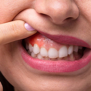 Close-up of woman showing red and inflamed gums