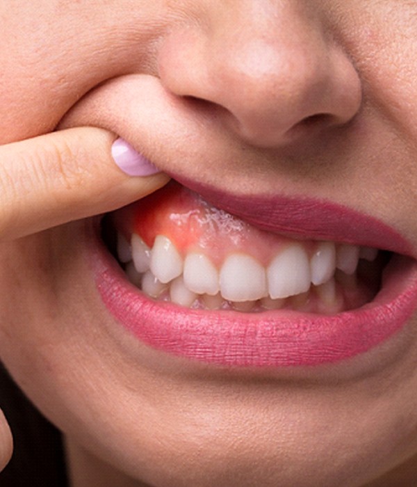 Close-up of woman showing red and inflamed gums