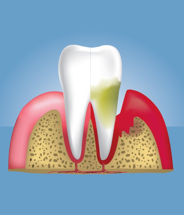 Animated tooth before and after pocket reduction