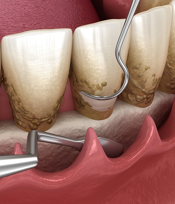 Animated smile during regenerative gum procedures