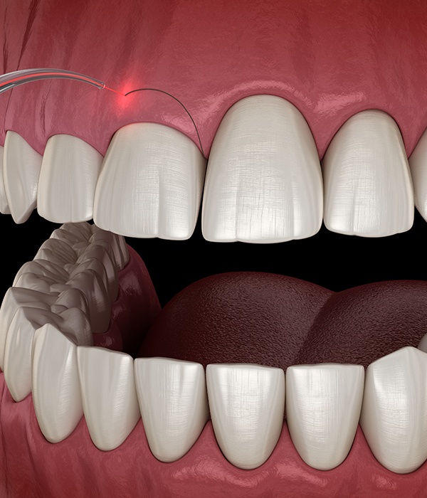 Animated smile during crown lengthening treatment