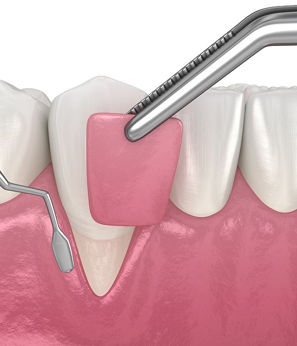 Animated smile during gum grafting process