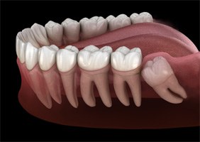 an illustration of an impacted wisdom tooth