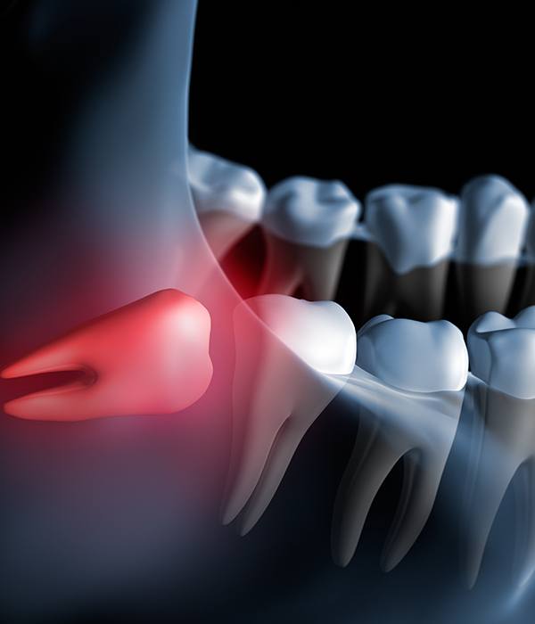 Animated smile with impacted wisdom tooth