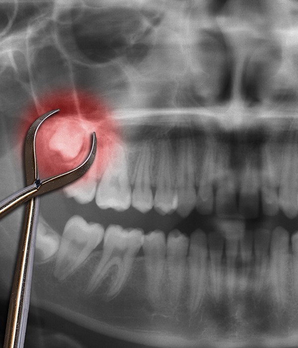 X-ray of smile with impacted wisdom tooth