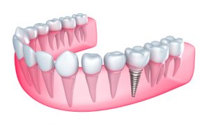 Dental implants in Colorado Springs provide secure and beautiful smiles. 