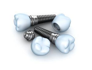 Restore your smile with dental implants in Colorado Springs.