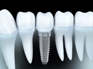 Benefit from affordable Colorado Springs dental implants.