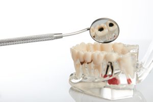 plastic teeth model showing gum disease