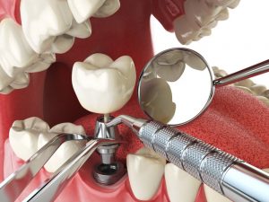 dental implant placement tools mouth open