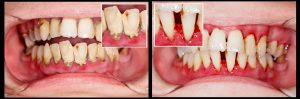 man with yellow teeth infected gums