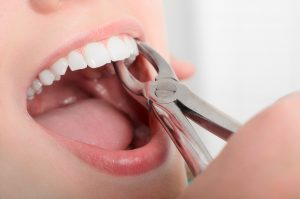 woman preparing to have tooth extracted