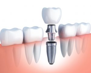 implant diagram