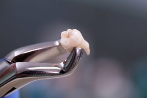 A pair of dental forceps holding an extracted tooth.