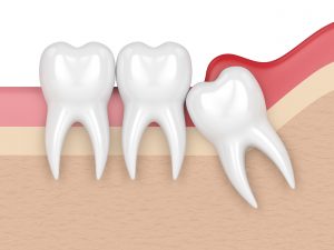 Impacted wisdom tooth causing gum irritation