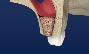 Digital image of a bone graft