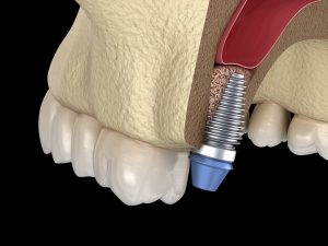 Digital model of dental bone graft procedure