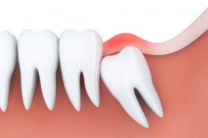 Image of inflammation requiring wisdom tooth removal