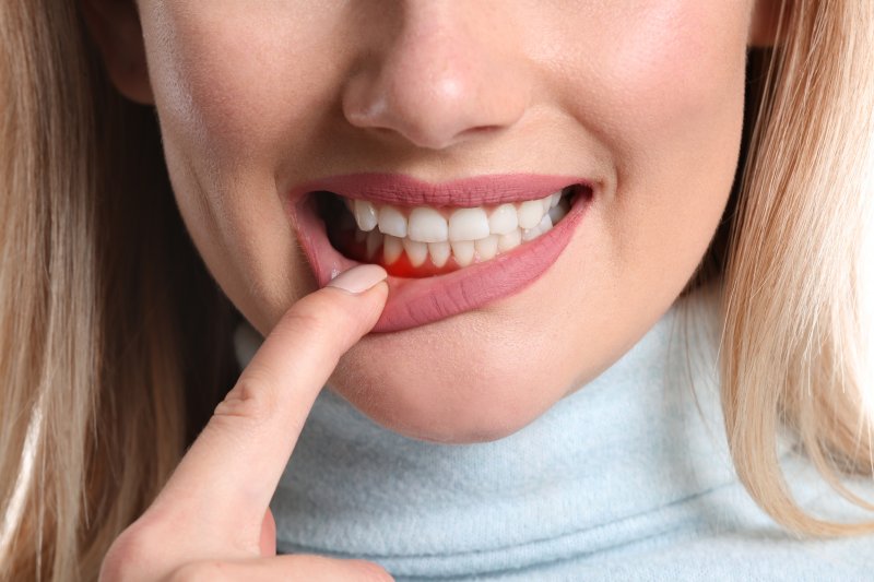 patient smiling and pointing to gum inflammation
