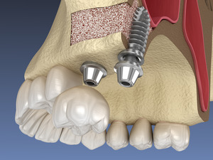 Two dental implants in upper jaw after sinus lift