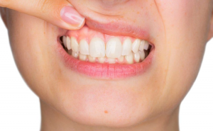 a closeup of a patient’s gums
